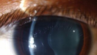 smartphone-diagnosi-glaucoma