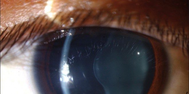 smartphone-diagnosi-glaucoma